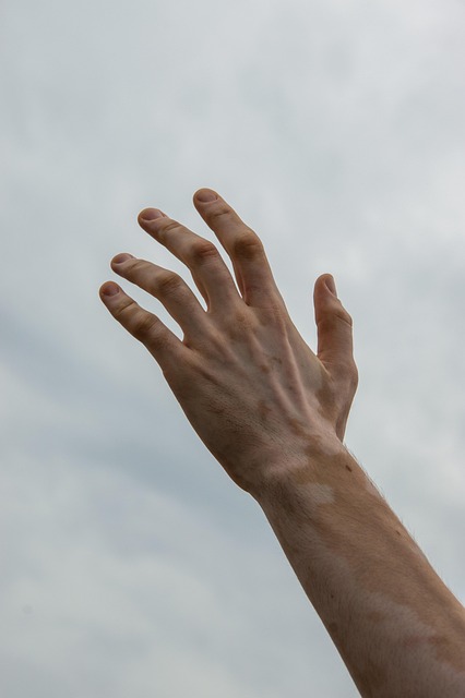 Vitiligo